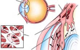 Phòng ngừa giảm thị lực ở người già